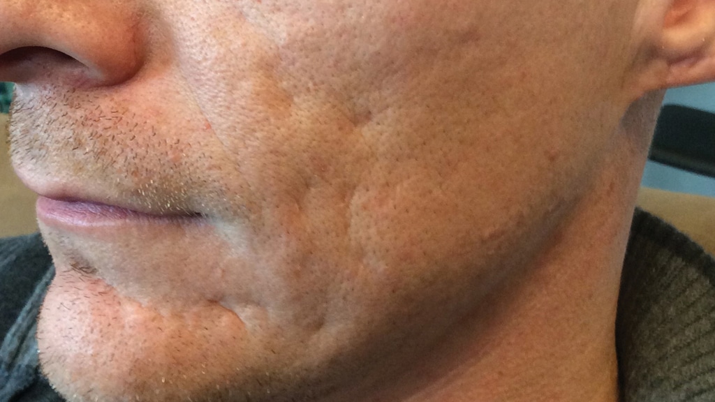 Acne_Patient_1_before