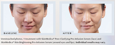 DiamondGlow Before & After Results - 1 treatment with SkinMedica® Pore Clarifying Pro-Infusion Serum (face) and SkinMedica® Skin Brightening Pro-Infusion Serum (around eyes and lips). Individual results may vary.