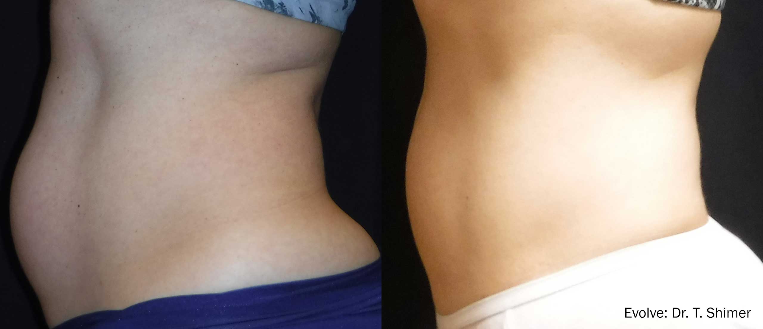 Evolve Treatment Before & After